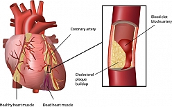 CardioZest, a wonderful herbal supplements for coronary heart disease